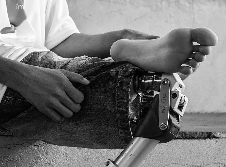 Homem sentado num degrau, com a prótese de perna apoiada ao lado do pé descalço.